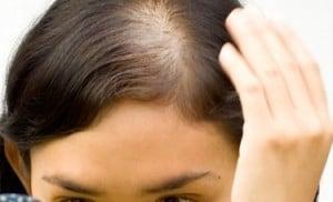 Hair Loss Pattern Baldness In Women