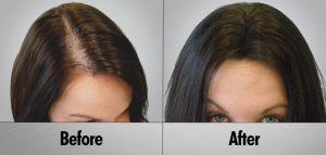 Alopecia Treatment Before and After