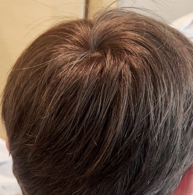 Close view of brown hair and crown in a CRLAB campaign photograph
