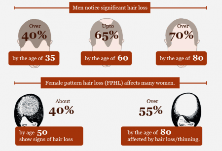 Is There A Solution for Baldness Infographic on Baldness And Hair Loss Facts Infographic