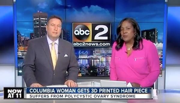 Colombia Woman Gets 3D Printed Hair Piece